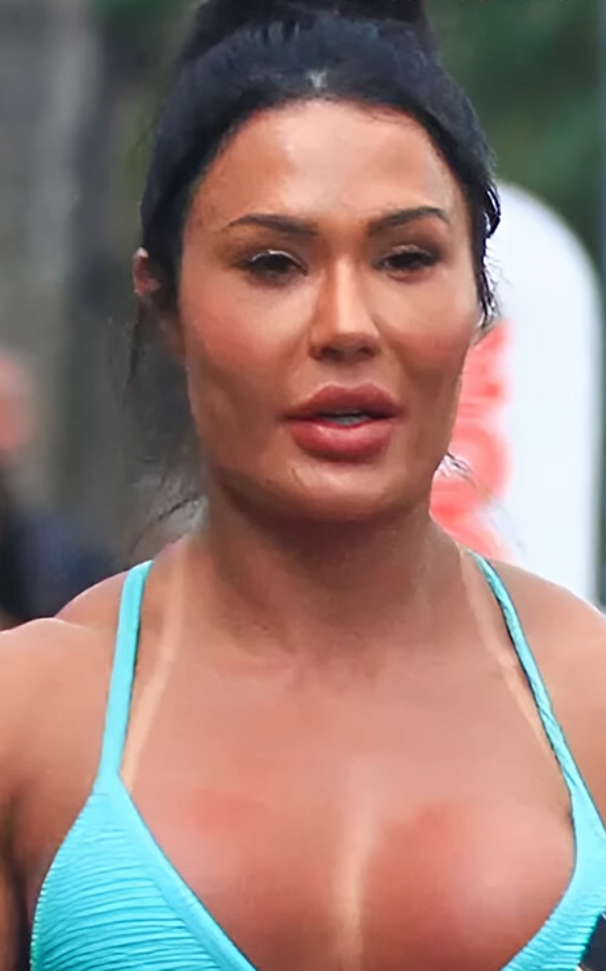 Gracyanne Barbosa faz procedimento para retirar procedimentos do rosto - Reprodução/Instagram