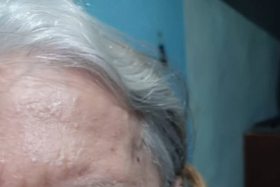 Idosa de Arraial do Cabo corre risco de perder olho enquanto aguarda cirurgia emergencial há 5 meses