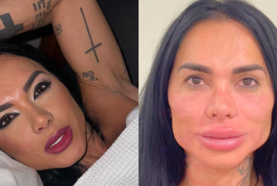 Kamila Simioni choca web ao exibir resultado de harmonização facial