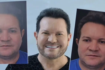 Ximbinha faz harmonização facial e compartilha resultado