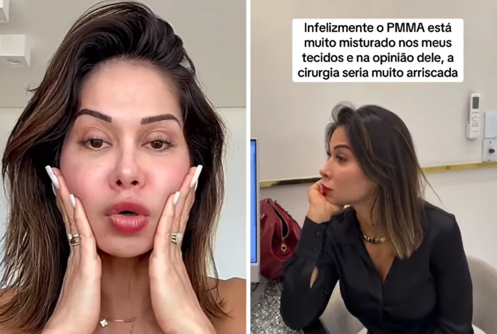 Maíra Cardi compartilha sua saga para tentar desfazer procedimento no seu rosto - reprodução TikTok