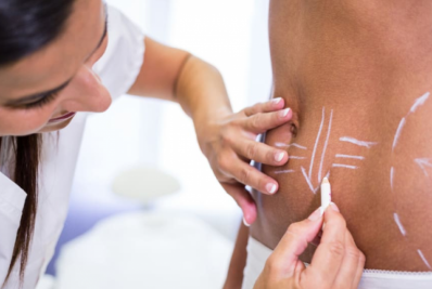 Médicos alertam sobre os perigos da lipoaspiração em locais não autorizados