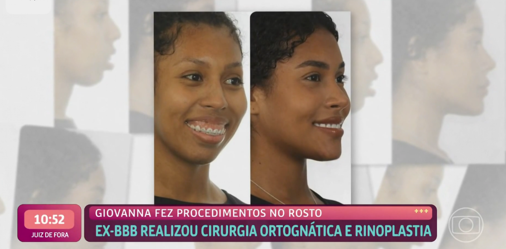 Giovanna esclarece cirurgia ortognática - TV Globo