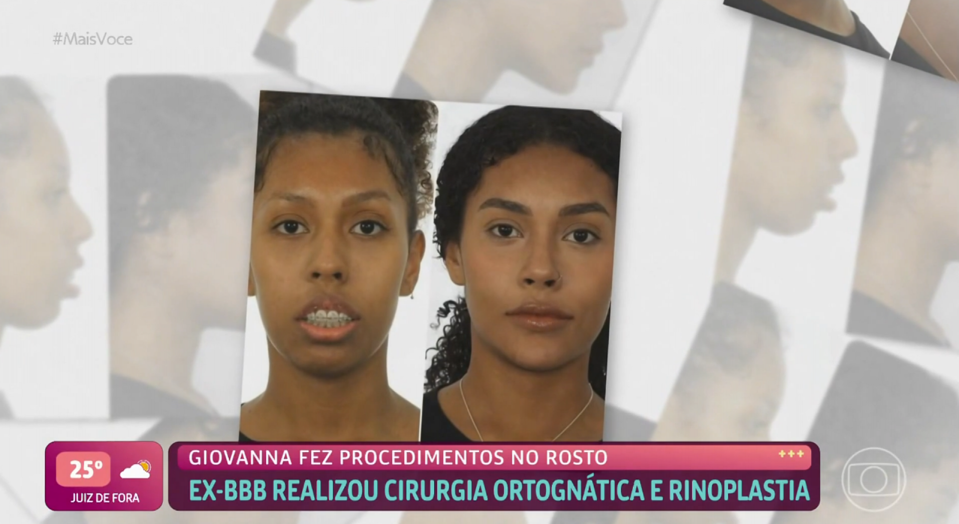 Giovanna esclarece cirurgia ortognática - TV Globo