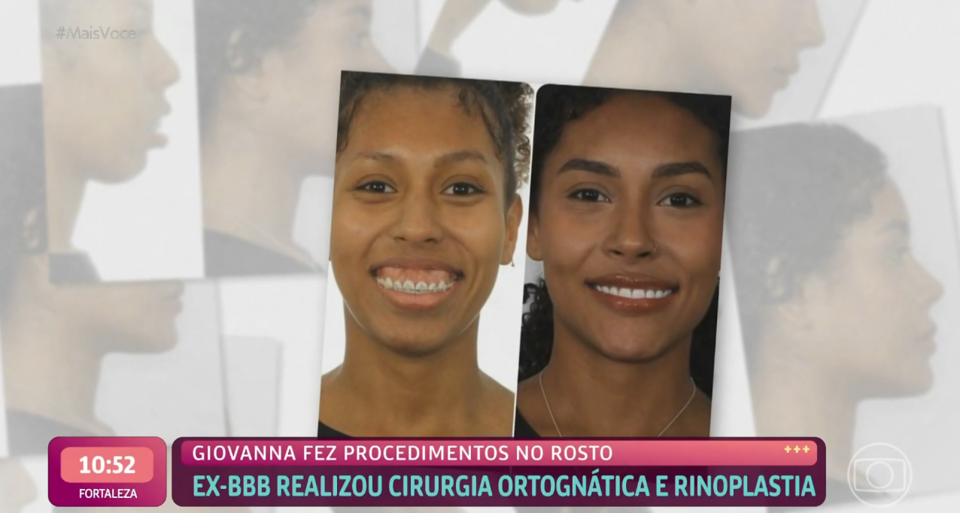 Giovanna esclarece cirurgia ortognática - TV Globo