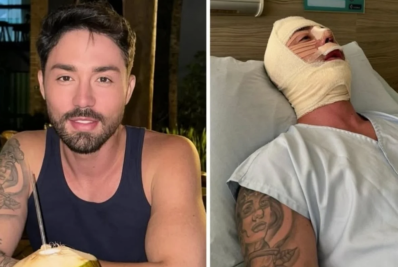Rico Melquiades passa por 11ª cirurgia facial