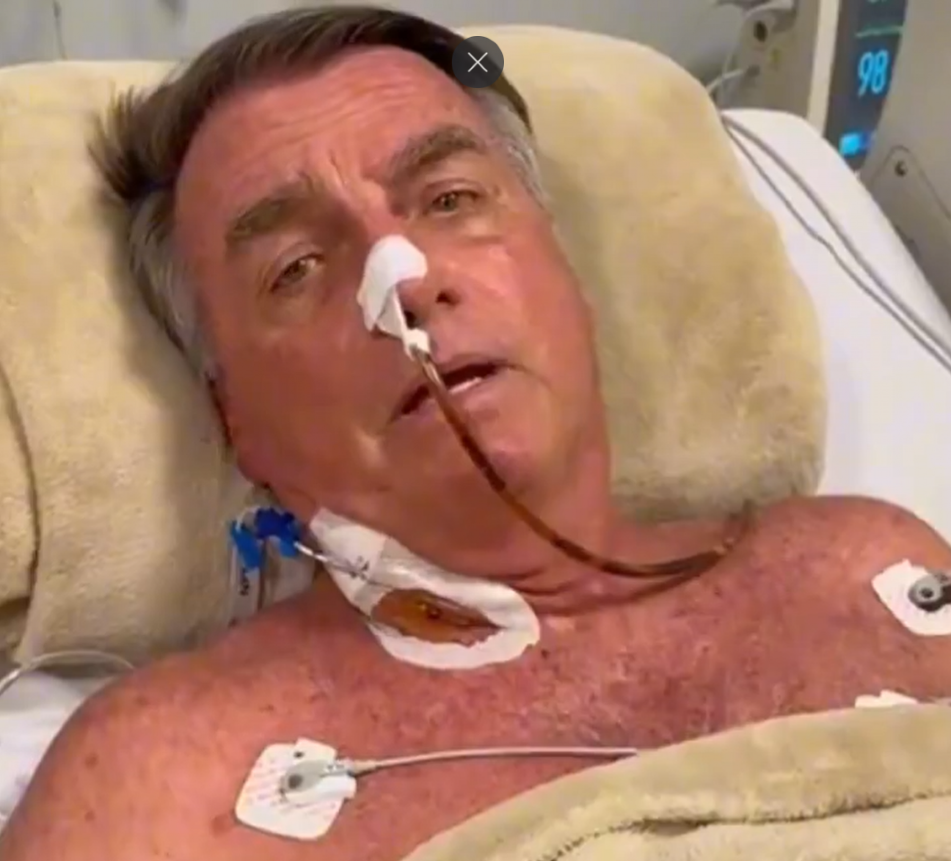 Bolsonaro passou por um procedimento de desobstru&ccedil;&atilde;o no intestino em Bras&iacute;lia  - Reprodu&ccedil;&atilde;o/Redes Sociais 