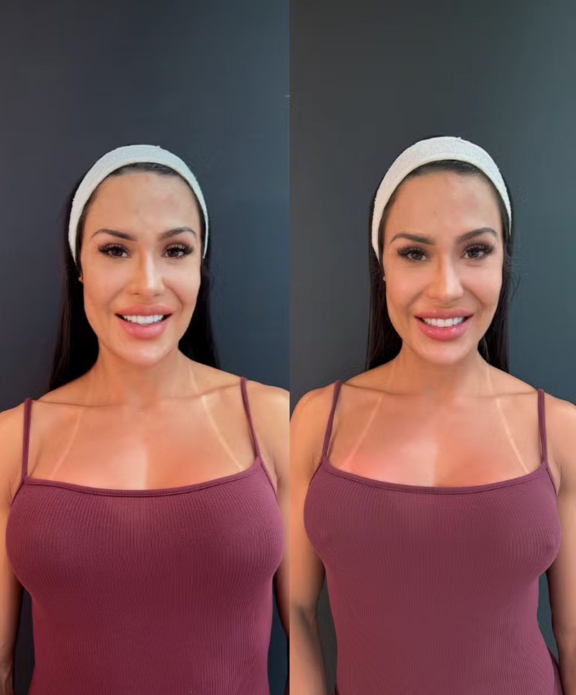 Influenciadora fitness mostra antes e depois do seu procedimento &iacute;ntimo realizado ap&oacute;s sua sa&iacute;da do reality