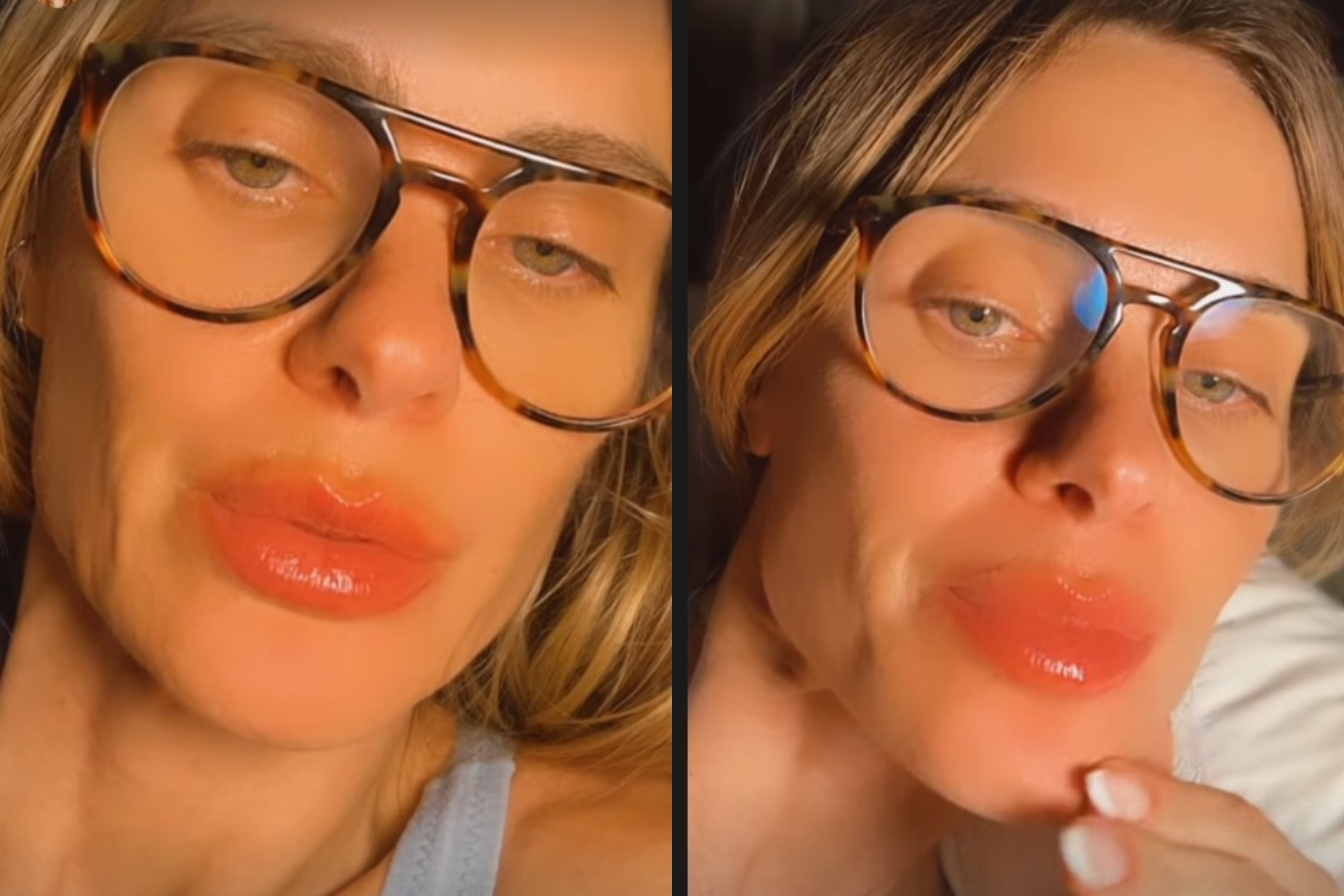 Carolina Dieckmann mostra reação alérgica na boca - Reprodução Instagram