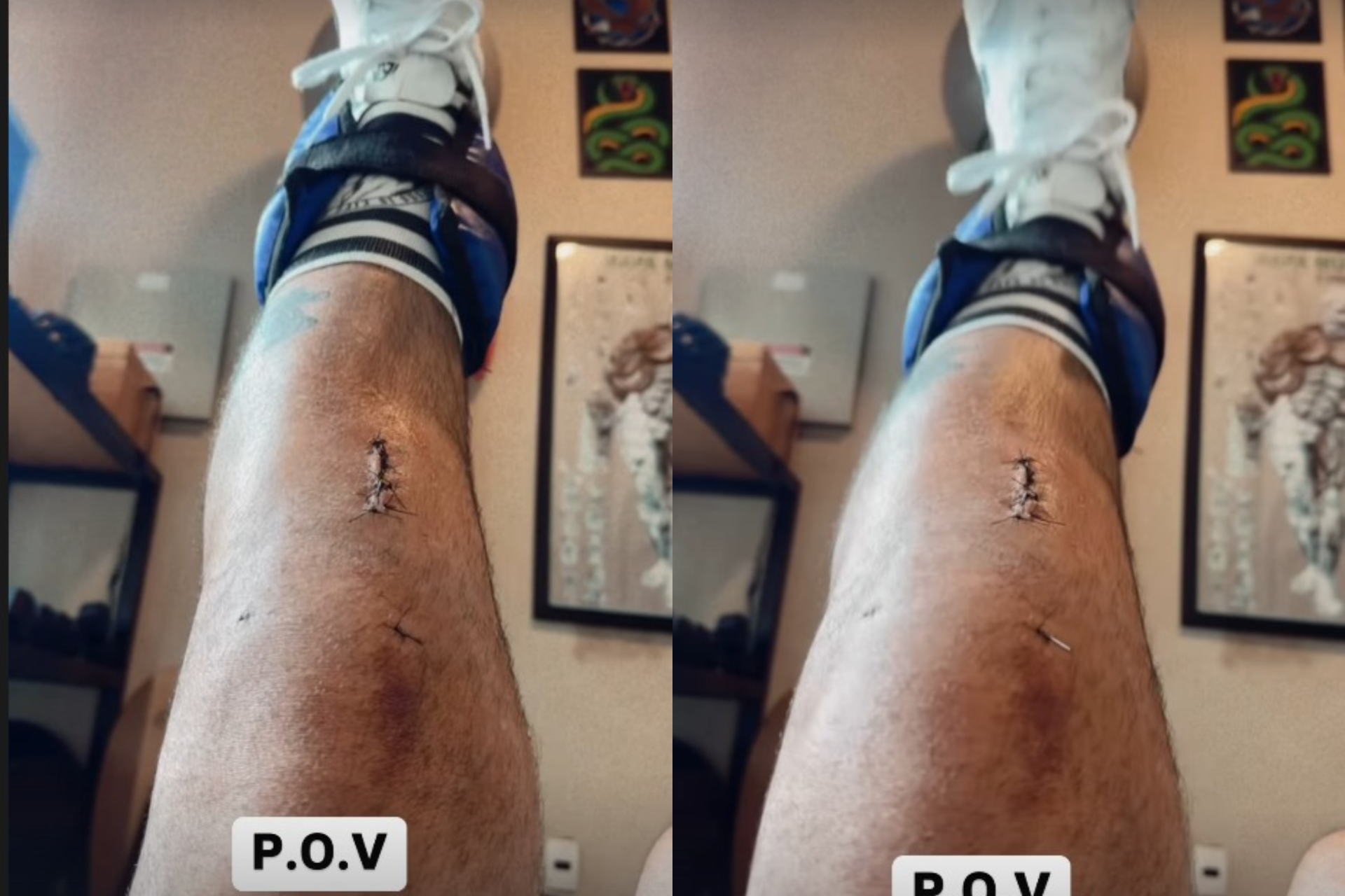 Juliano Cazarré mostra cicatriz no joelho depois de cirurgia  - Reprodução Instagram