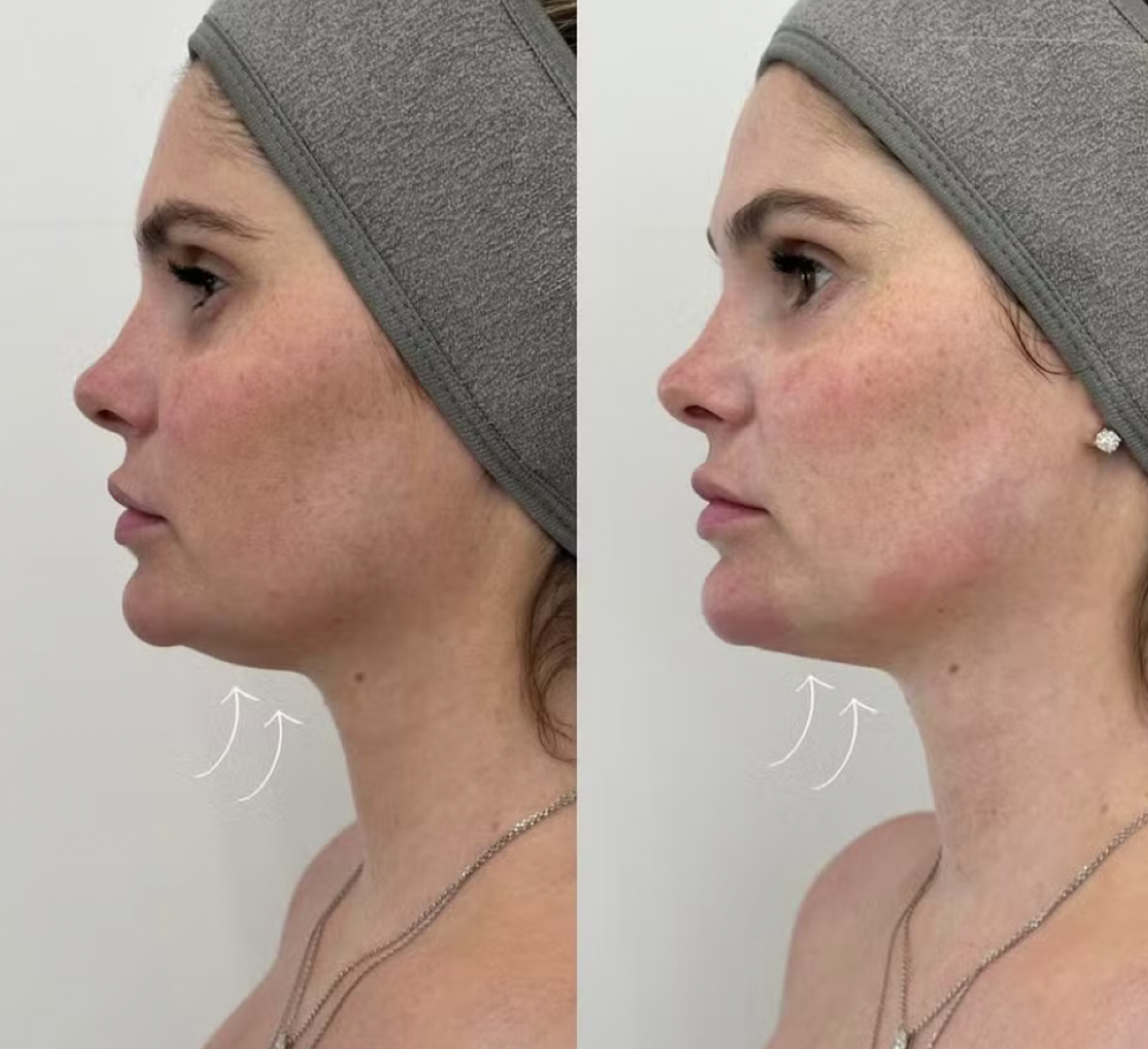 Antes e depois de Bárbara Evans - reprodução Instagram