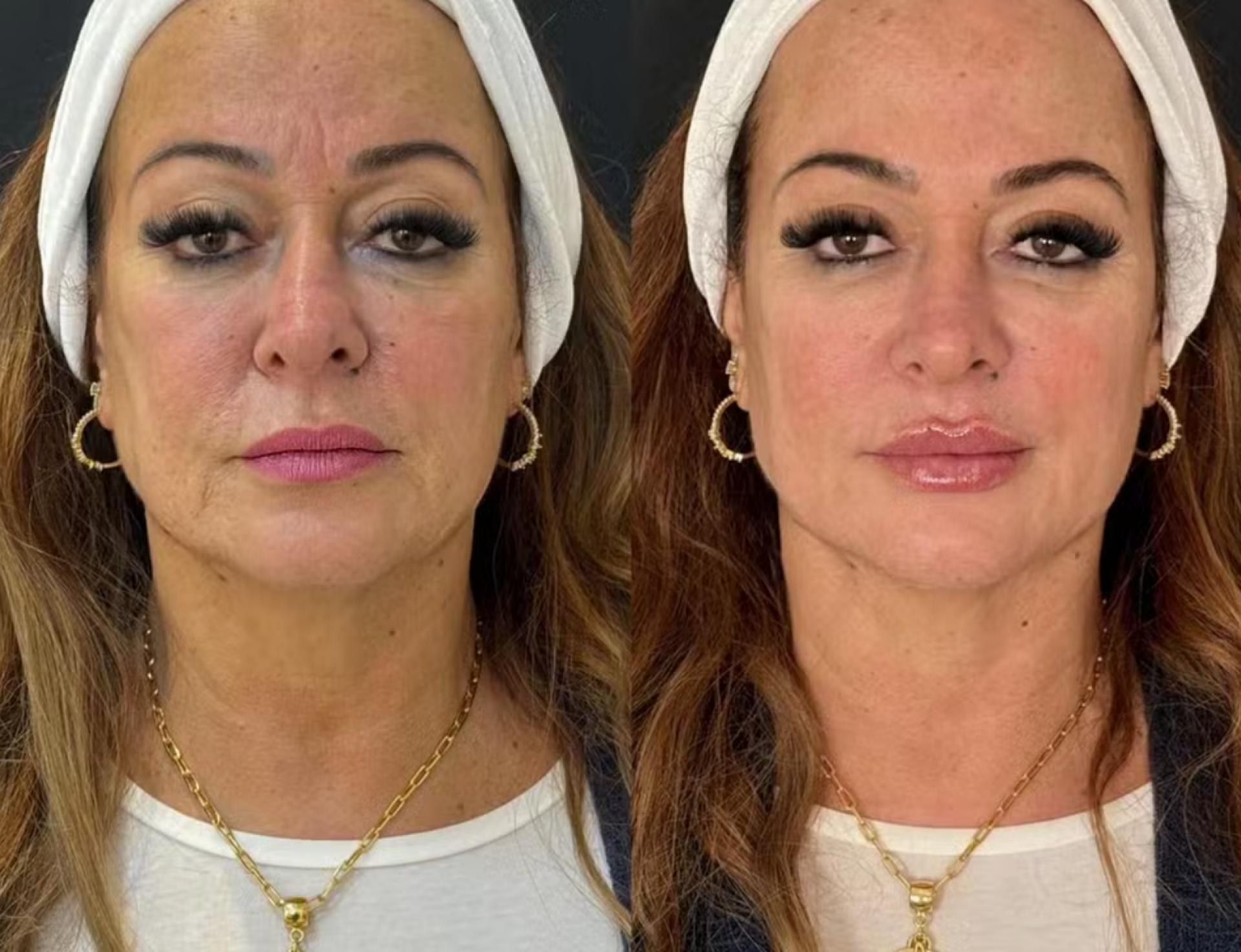 antes e depois de Nadine - reprodução Instagram