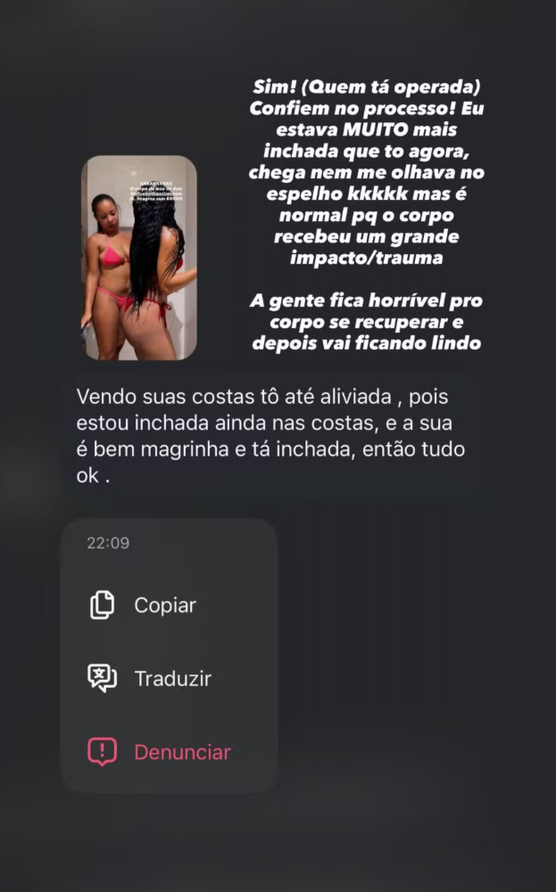 Lorena Maria passou por lipoaspiração e mastopexia meses depois de dar à luz Rás - reprodução Instagram