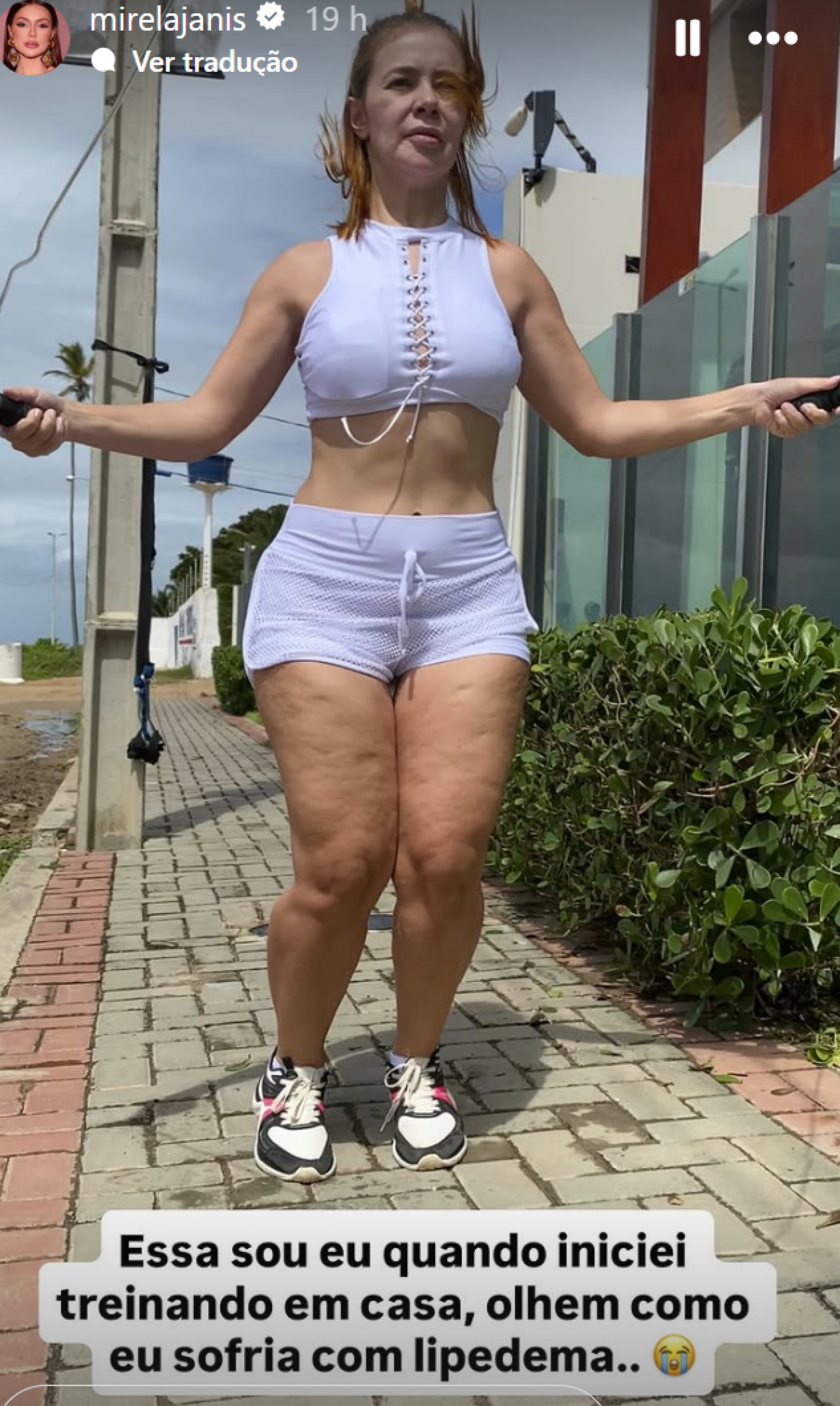 Mirela Janis exibe antes e depois das pernas e fala sobre luta contra o lipedema
 - reprodução Instagram