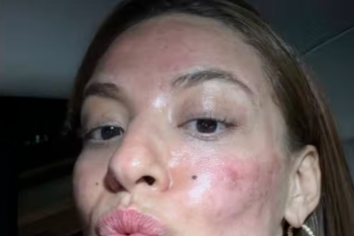 Beatriz Reis mostra resultado de tratamento a laser