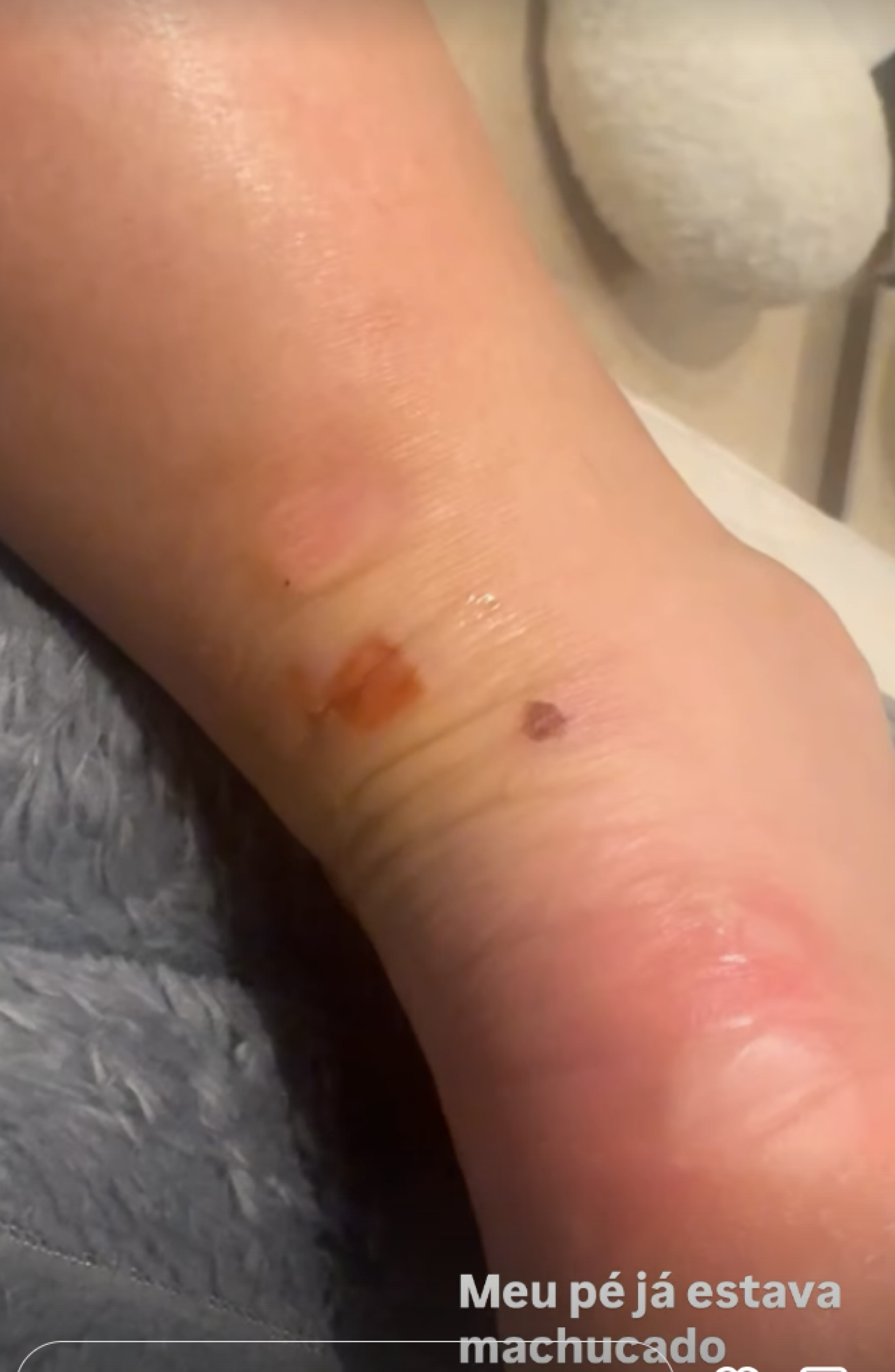 Gabi Martins exibe machucados após ensaio da Vila Isabel - reprodução Instagram