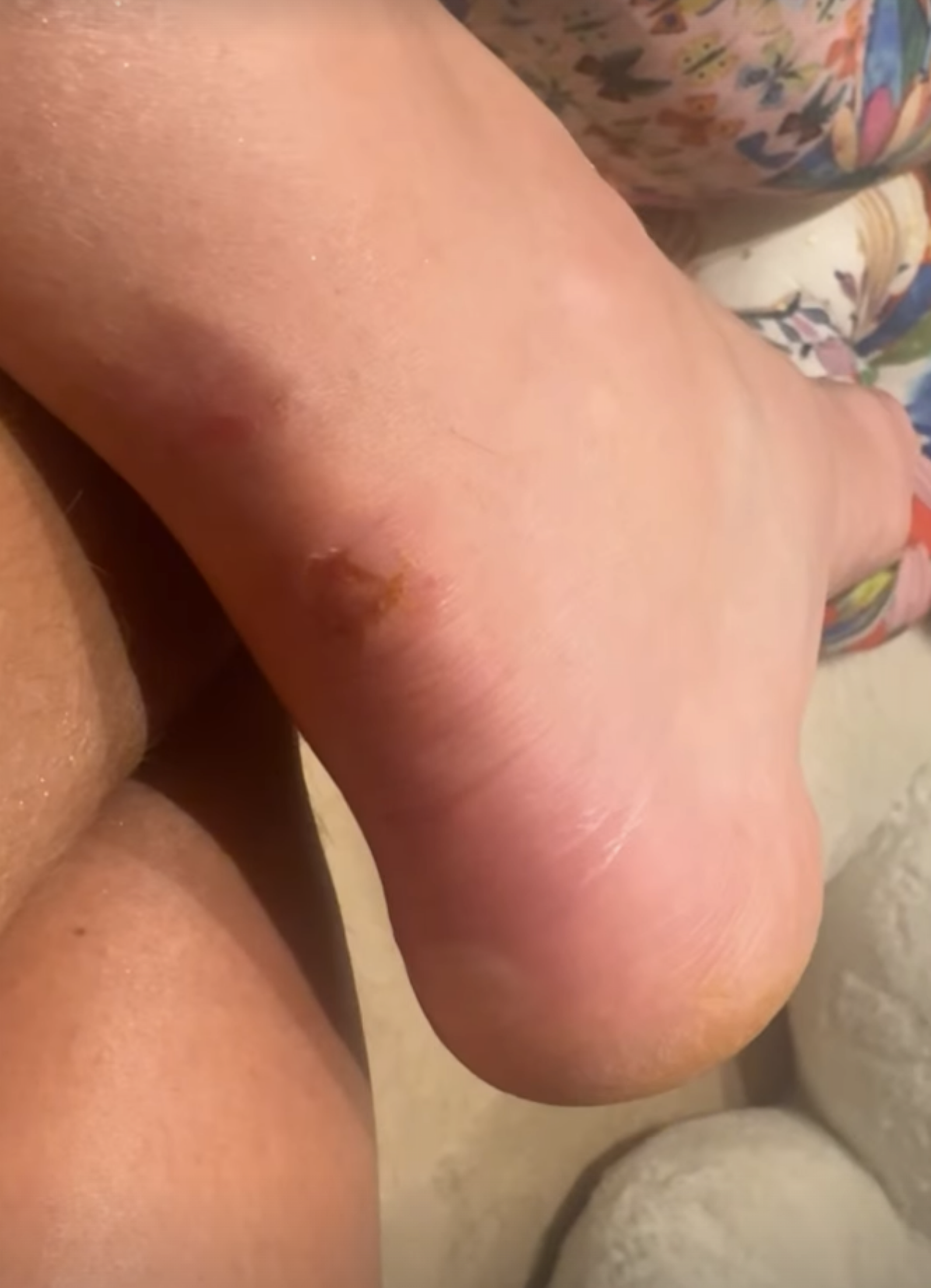 Gabi Martins exibe machucados após ensaio da Vila Isabel - reprodução Instagram