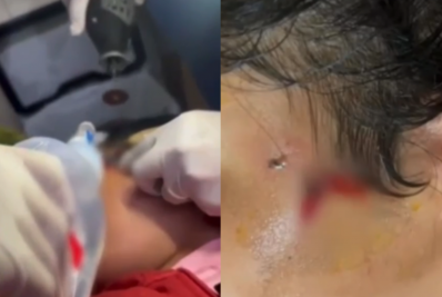 Vídeo: Menina de 10 anos fica com anzol preso na bochecha durante pescaria em Goiás