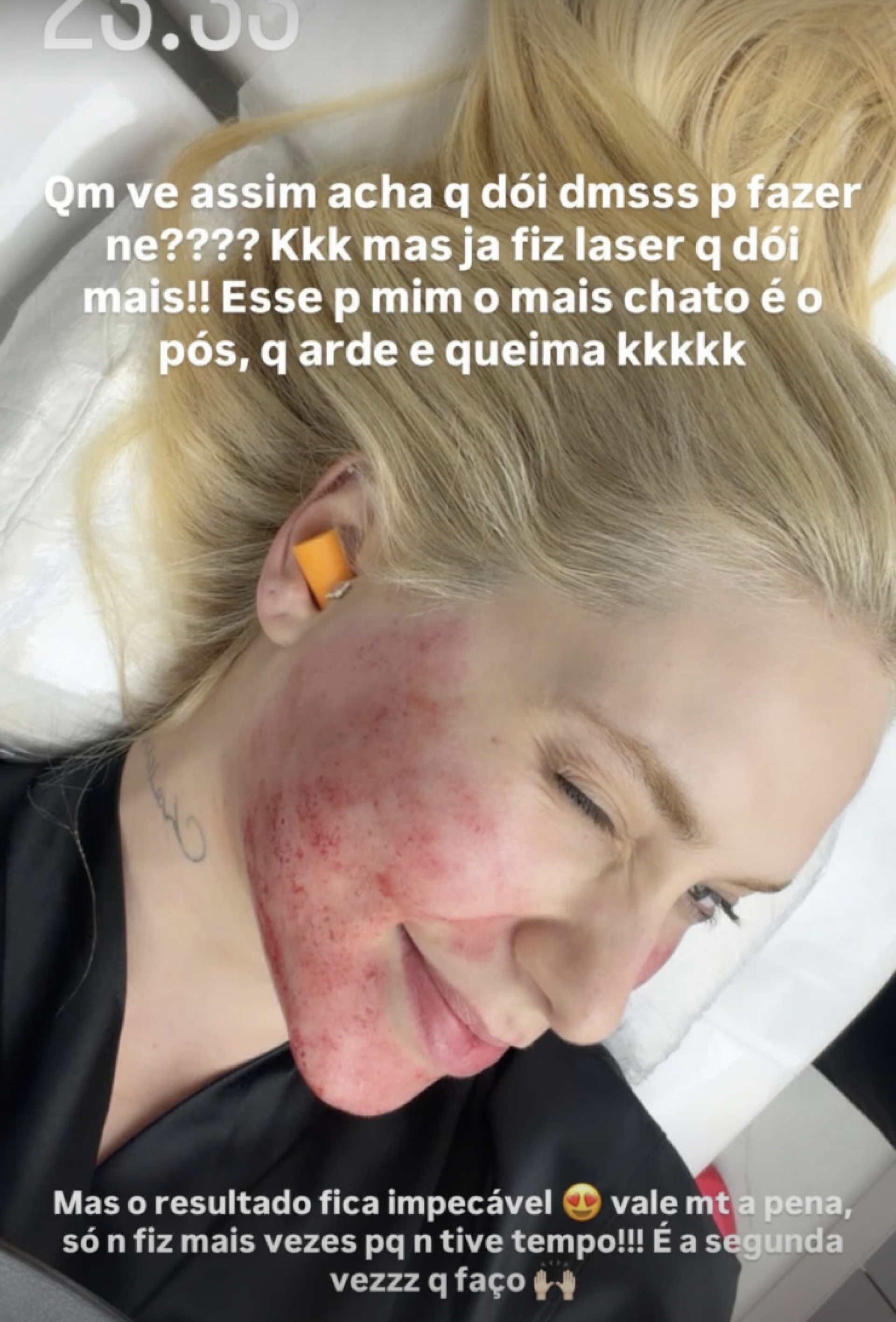 Virgínia mostra resultado de procedimentos - Reprodução/Instagram