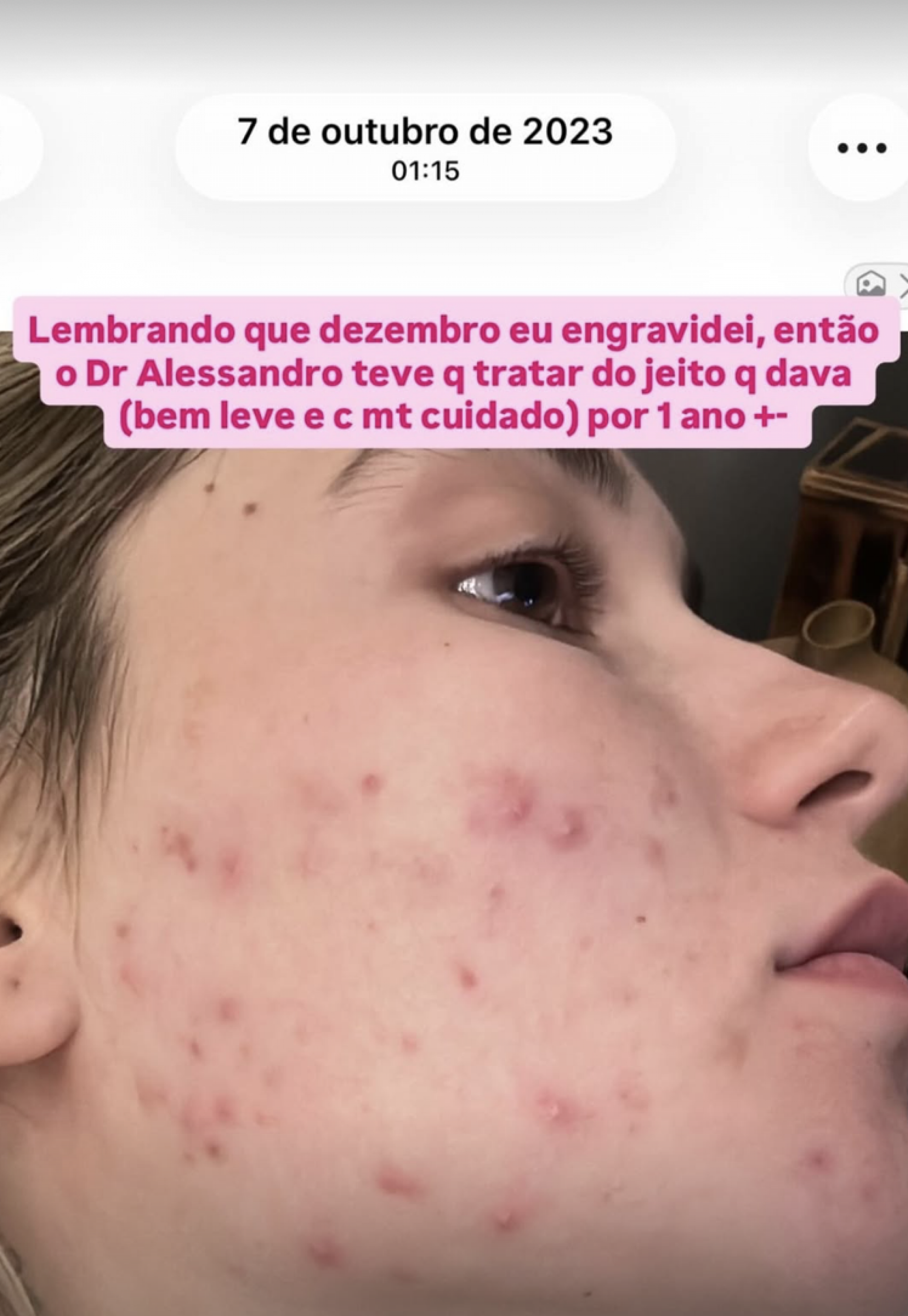 Virgínia mostra rosto com acne em 2023 - Reprodução/Instagram