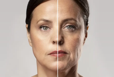 Face lifting: a cirurgia que está mudando a forma de envelhecer